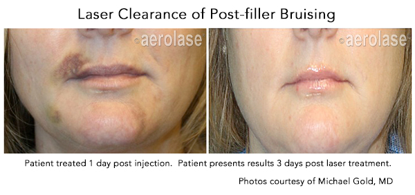 Enhancing Patient Outcomes by Accelerating Recovery Time with Laser Treatments