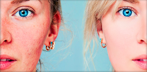 Rosacea