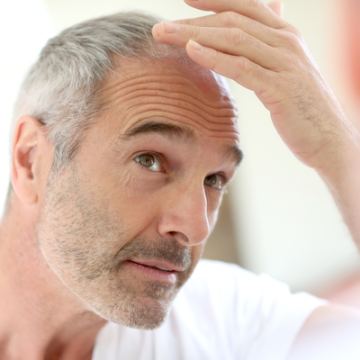 Hairloss