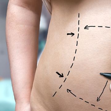 Cool Sculpting