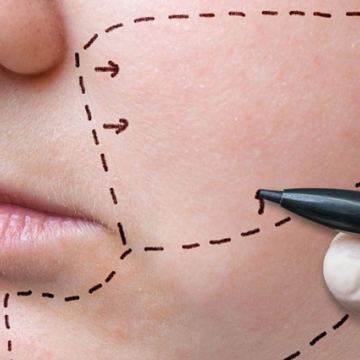 SI Cheek Implant 425