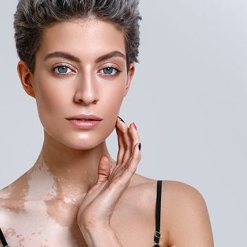 SI Vitiligo 425