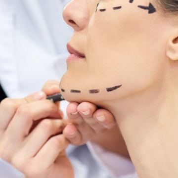 Face lift