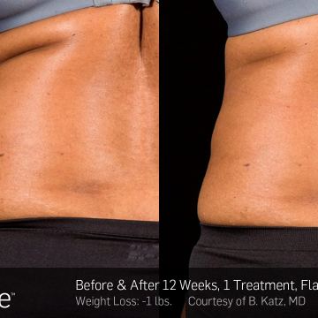 Sculpsure bxa 12b