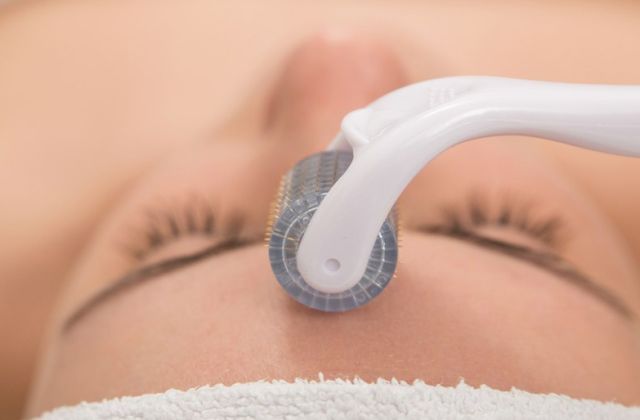 Microneedling