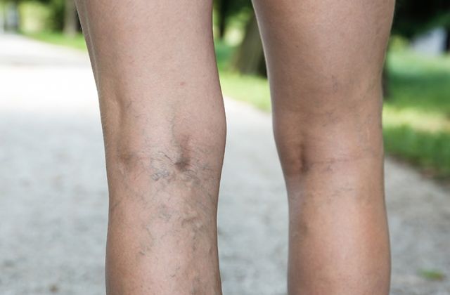 Sclerotherapy