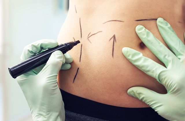 Surgical Body Contouring