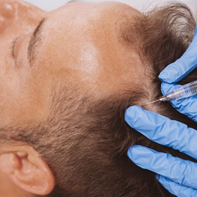Amspa hair restoration 09131