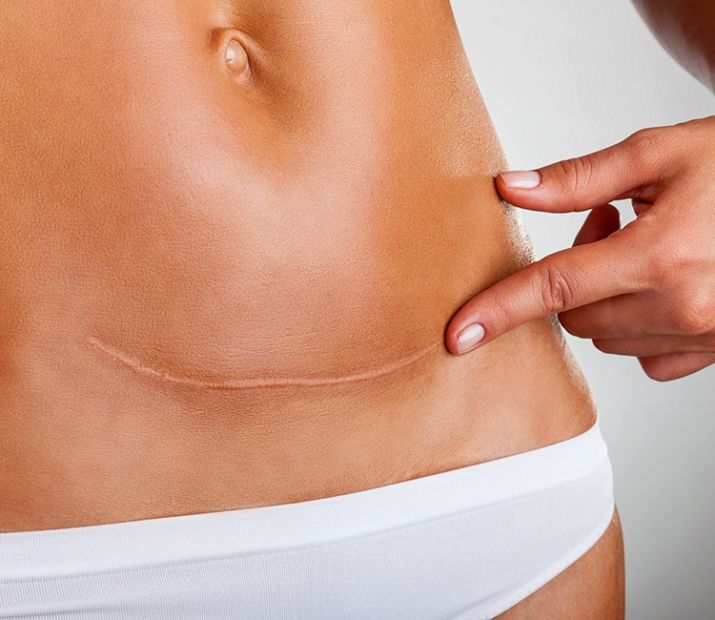 Scar Revision