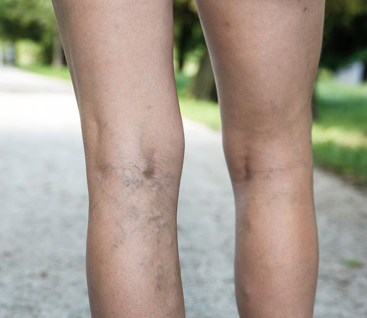 Sclerotherapy