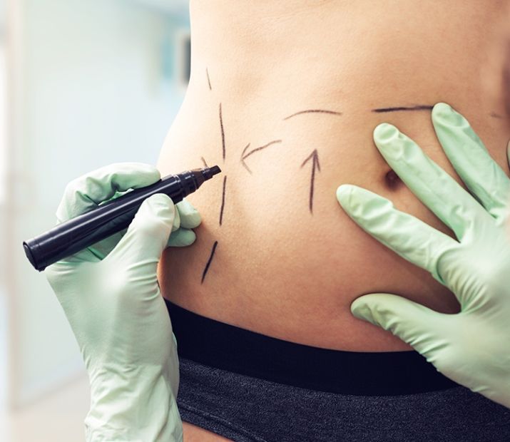 Surgical Body Contouring